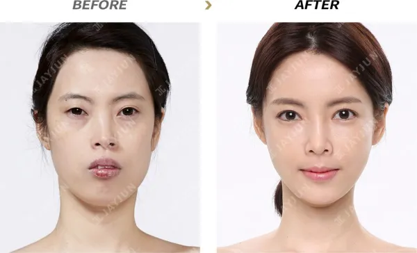 Before/After