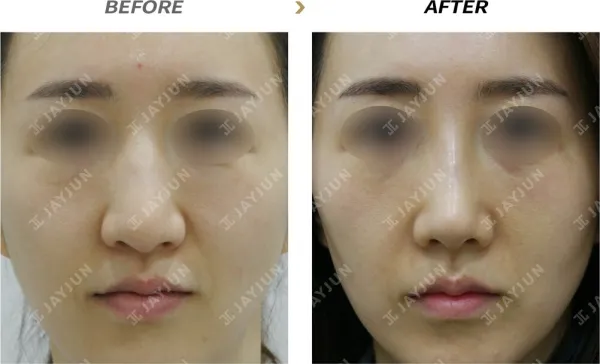 Before/After