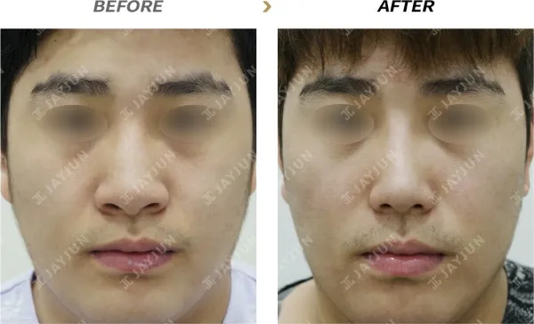 Before/After