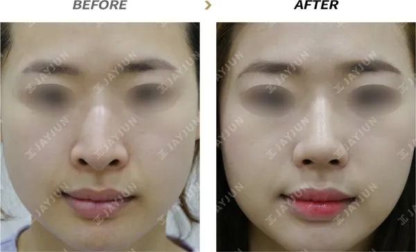 Before/After
