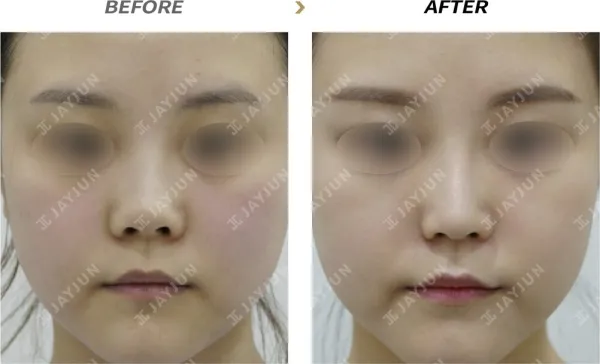 Before/After