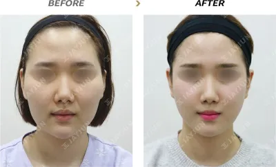 Before & After