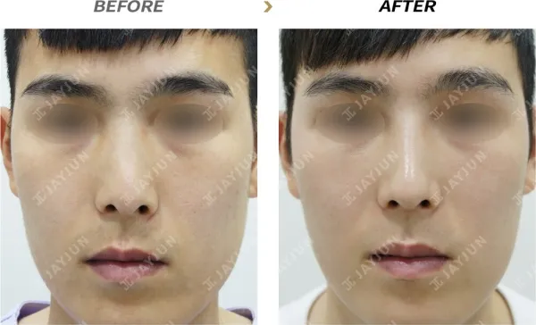 Before/After