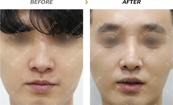 Before/After