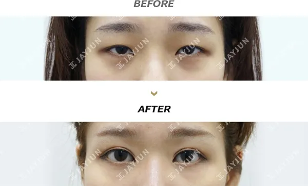 Before/After