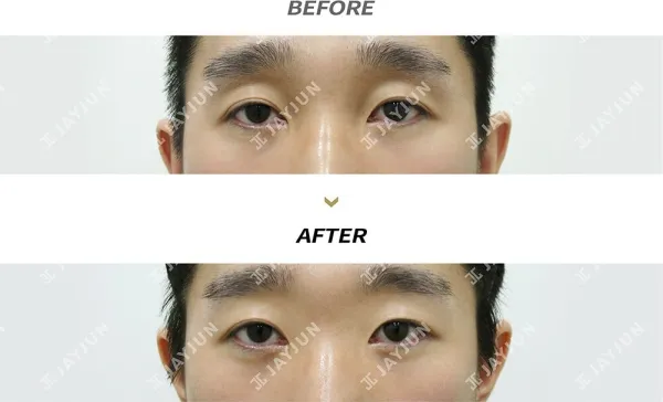 Before/After