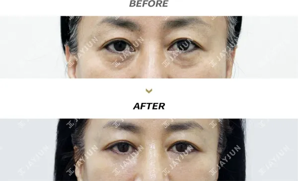 Before/After