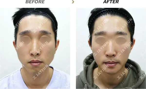 Before/After