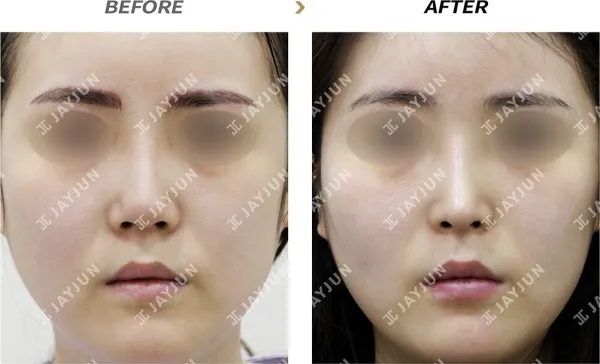 Before/After