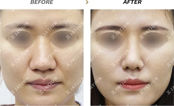 Before/After