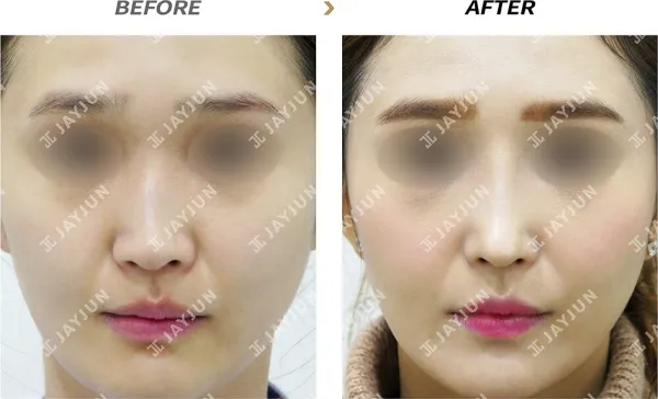 Before/After