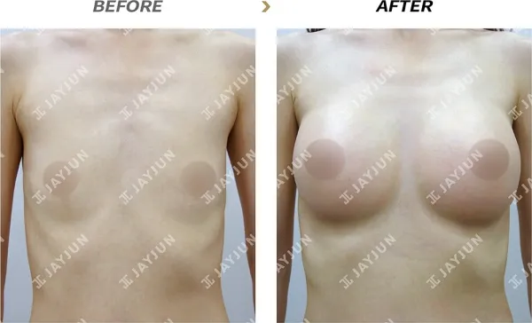Before/After
