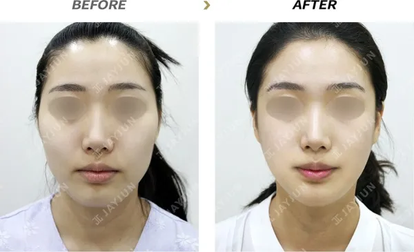 Before/After