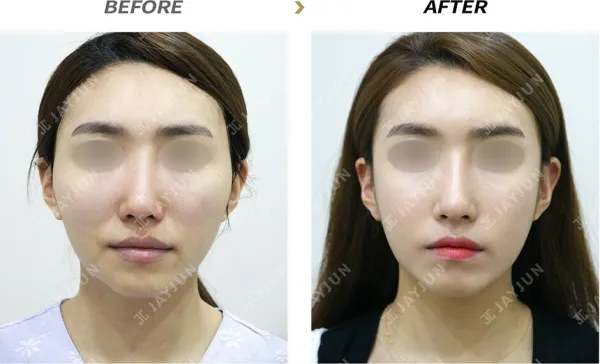 Before/After