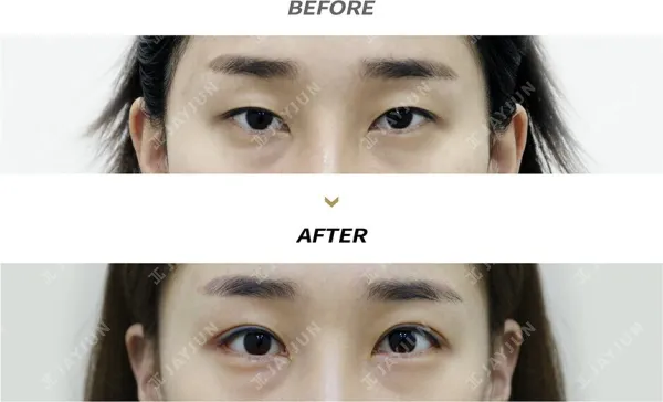 Before/After