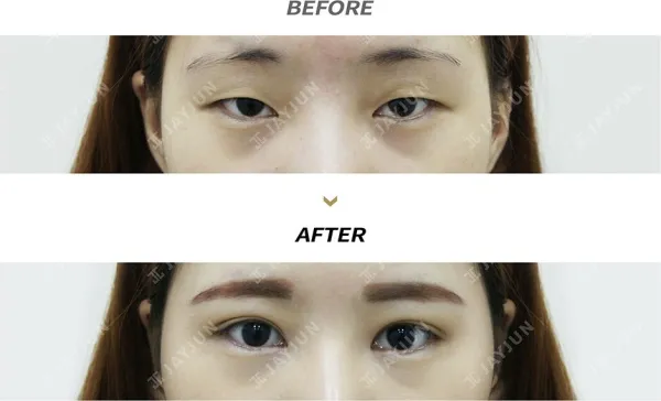 Before/After