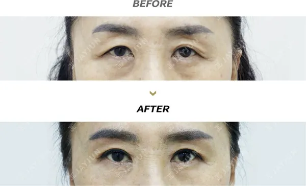 Before/After
