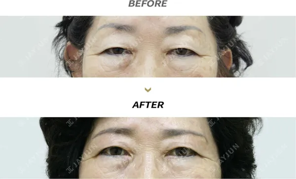 Before/After