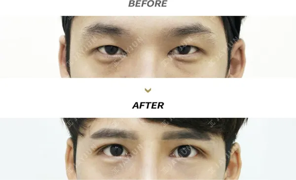 Before/After