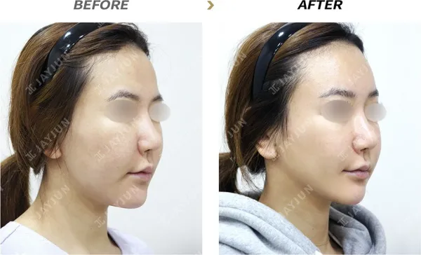 Before/After