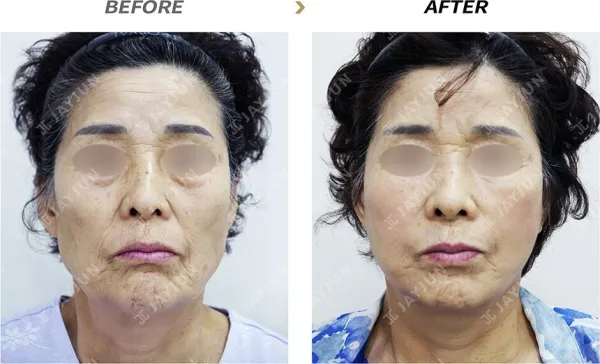 Before/After