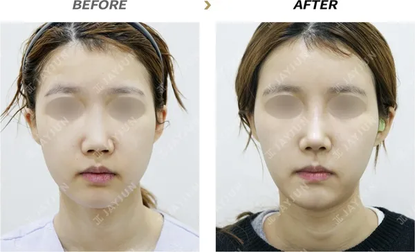 Before/After