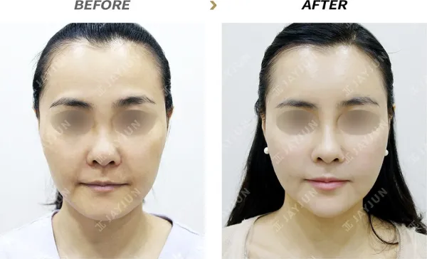 Before/After