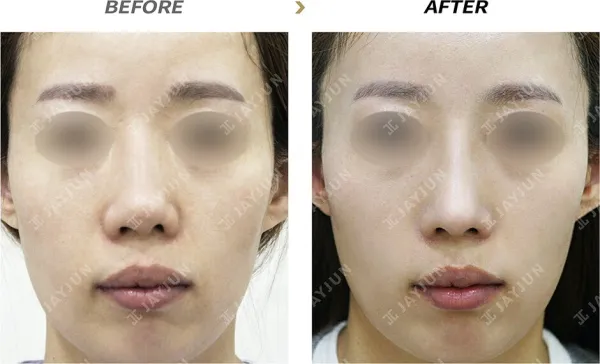 Before/After