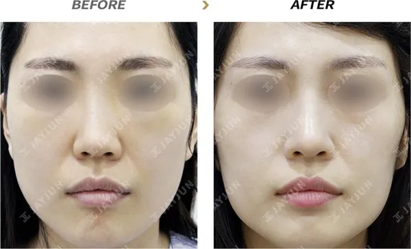Before/After