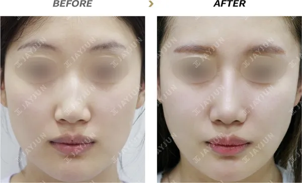 Before/After