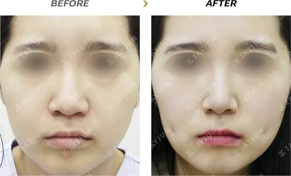 Before/After