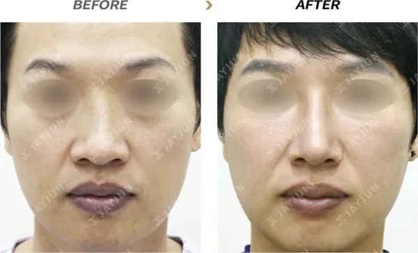 Before/After