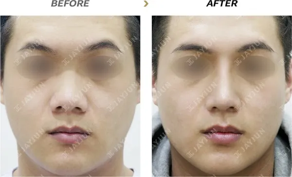 Before/After