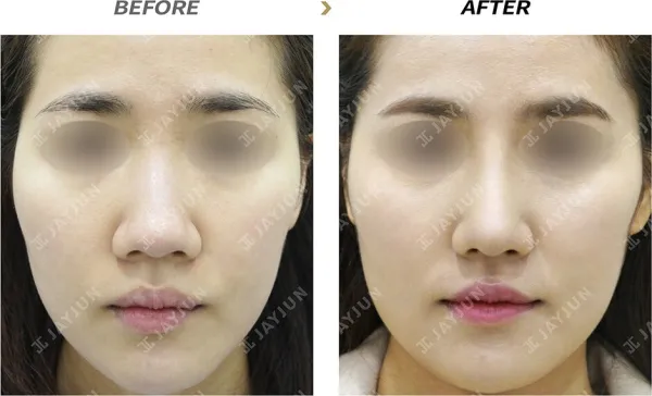 Before/After