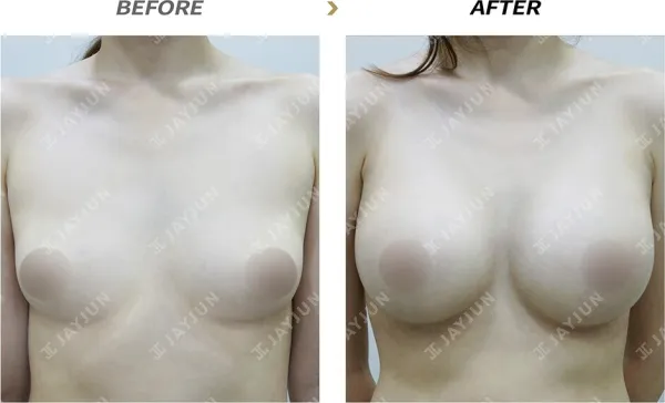 Before/After