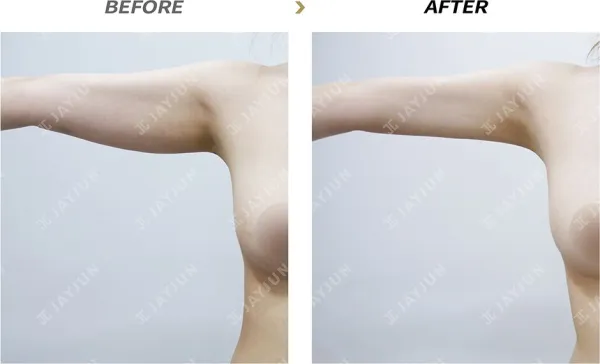 Before/After
