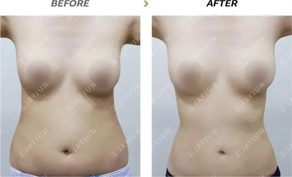 Before/After
