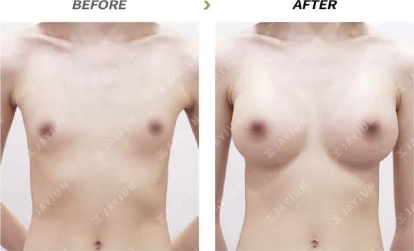 Before/After