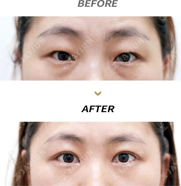 Before/After