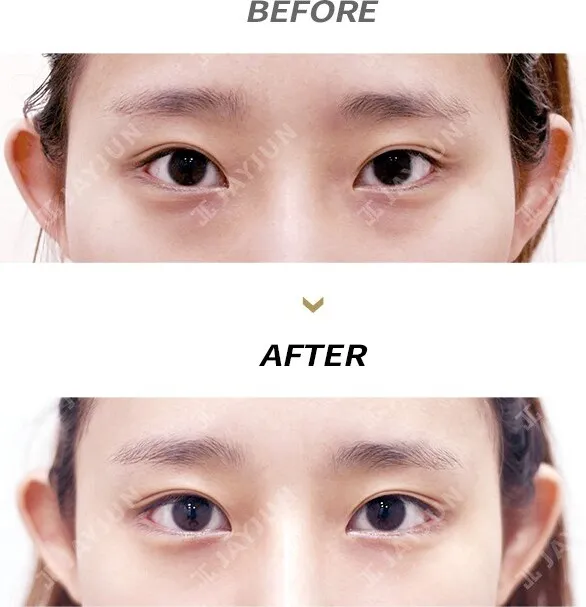 Before/After