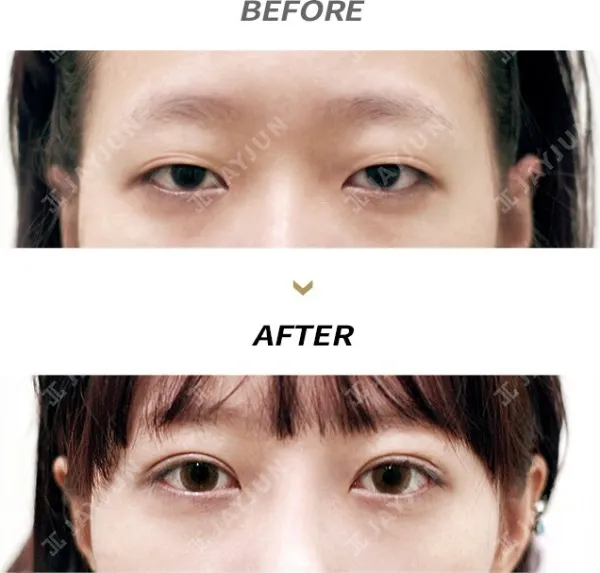 Before/After
