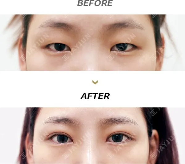 Before/After