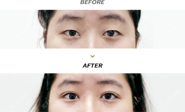 Before/After