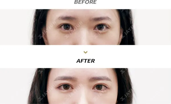 Before/After