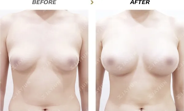 Before/After