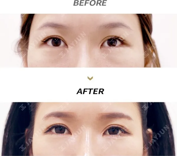 Before/After
