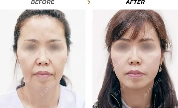 Before/After