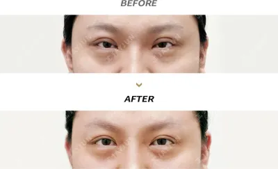 Before & After