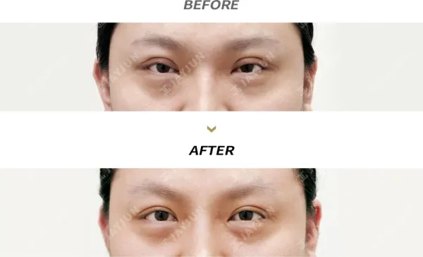 Before/After