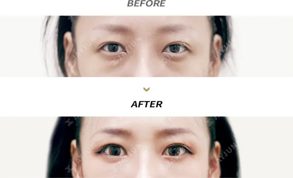 Before/After
